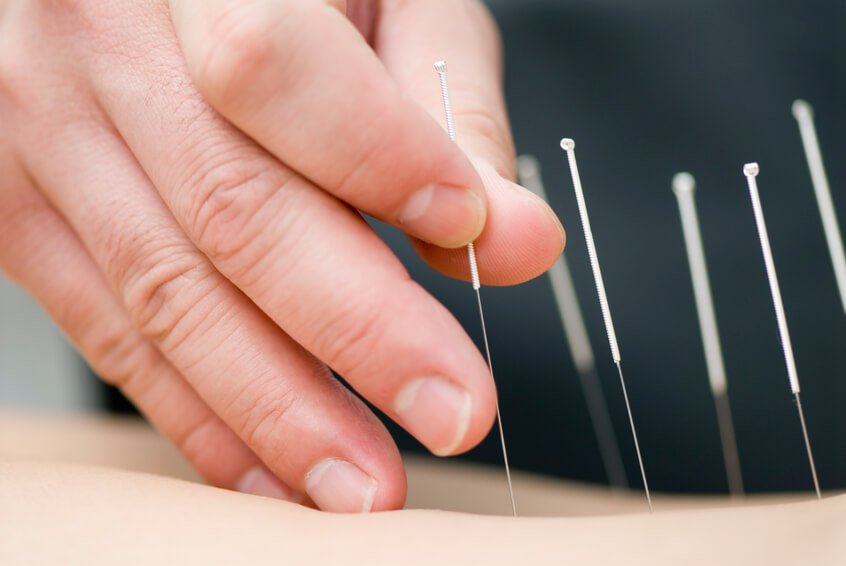 Art of Acupuncture - needle - man - Acupuncture