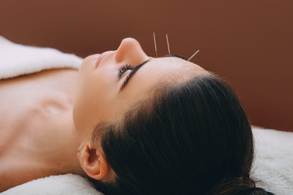 Woman having Acupuncture- Cosmetic Acupuncture - Acupuncture